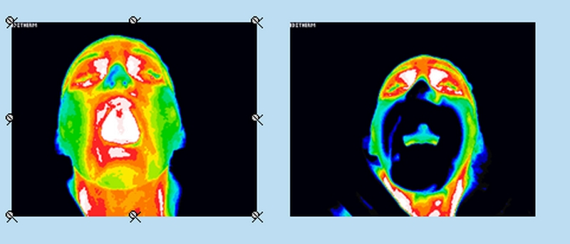 Intraoral Scanning Results